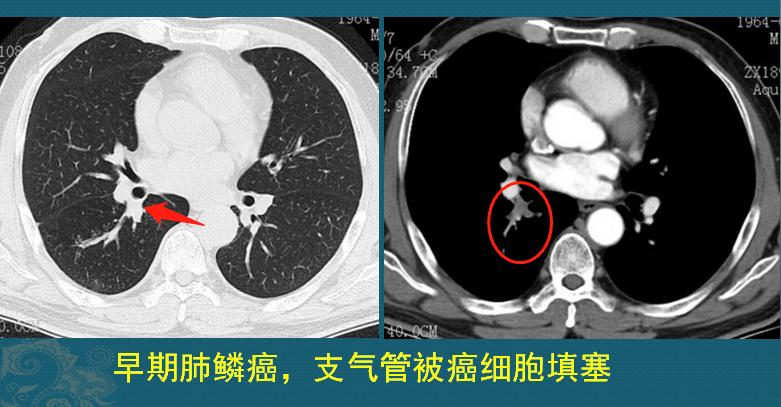 肺鳞癌是怎么长出来的?怎样早期发现?医生教你看CT片