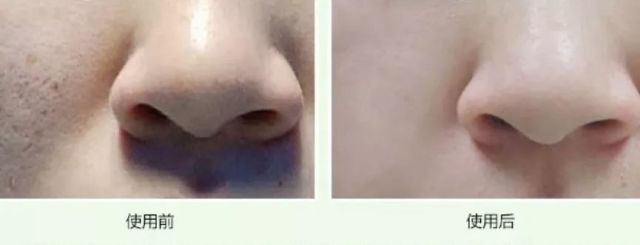 淡斑祛痘印什么产品最有效,淡斑美白祛痘印