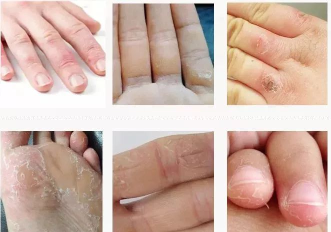 冬天脚跟干裂又起皮怎么办,冬天脚跟干裂起硬皮擦什么保湿好