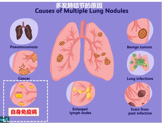 风湿结节的症状有哪些,风湿结节是什么症状