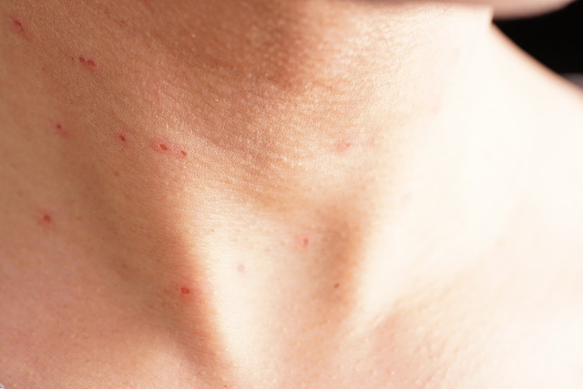 微剥脱点阵激光和强剥脱点阵激光,飞梭点阵激光和二氧化碳点阵激光