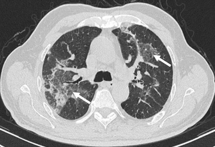 CACP2019:代华平:机化性肺炎的诊疗误区与防范