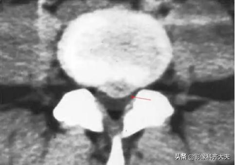 腰椎间盘突出是什么,腰椎间盘突出和腰间盘突出有区别吗