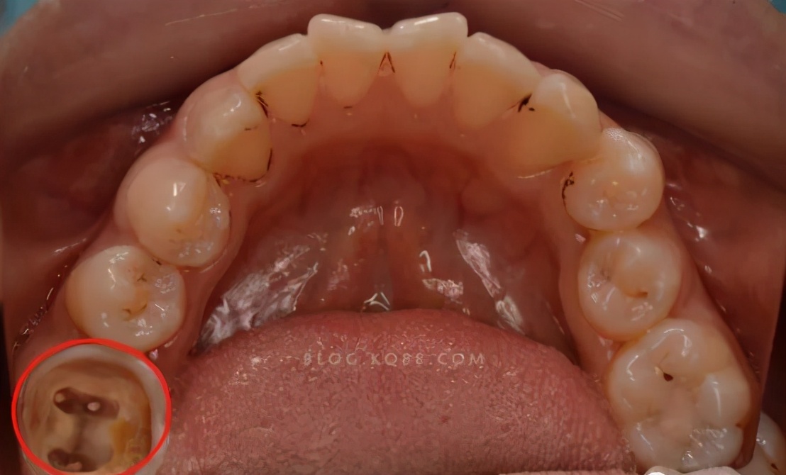 牙齿残根不疼不拔好吗,牙齿残根不疼