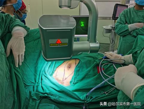 乳腺癌前哨淋巴结活检辅助手术,哈尔滨肿瘤医院做乳腺手术