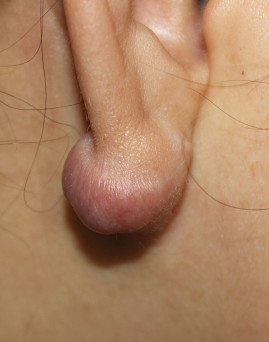 疤痕体质用什么方法祛疤好,欣奕除疤凝胶对疤痕体质有效果吗