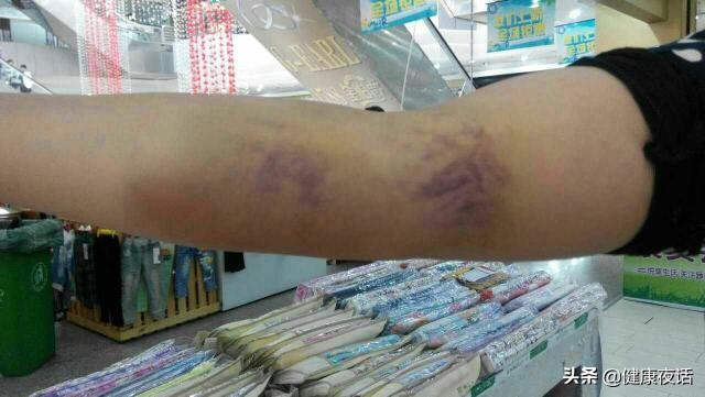 手臂抽血后鼓包肿了青紫疼痛,抽血后鼓包了要怎么处理