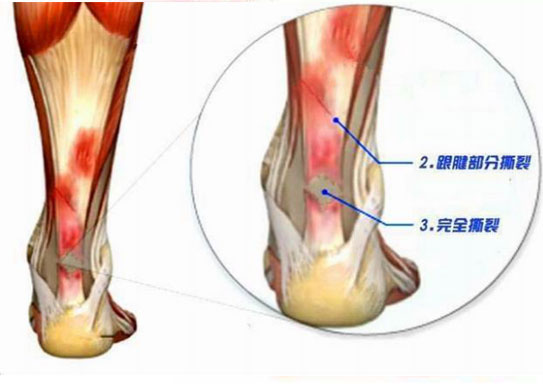 运动员骨头受伤,运动员脚部受伤
