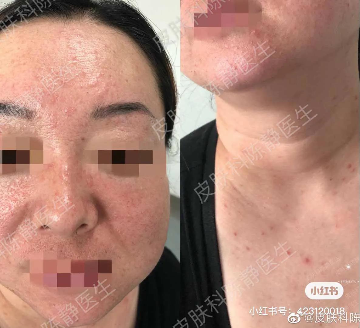 鼻头发红是日光性皮炎还是酒渣鼻,鼻头隐约有点红