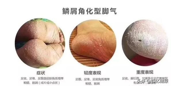 如何杀菌治脚气，看这篇文章就对了