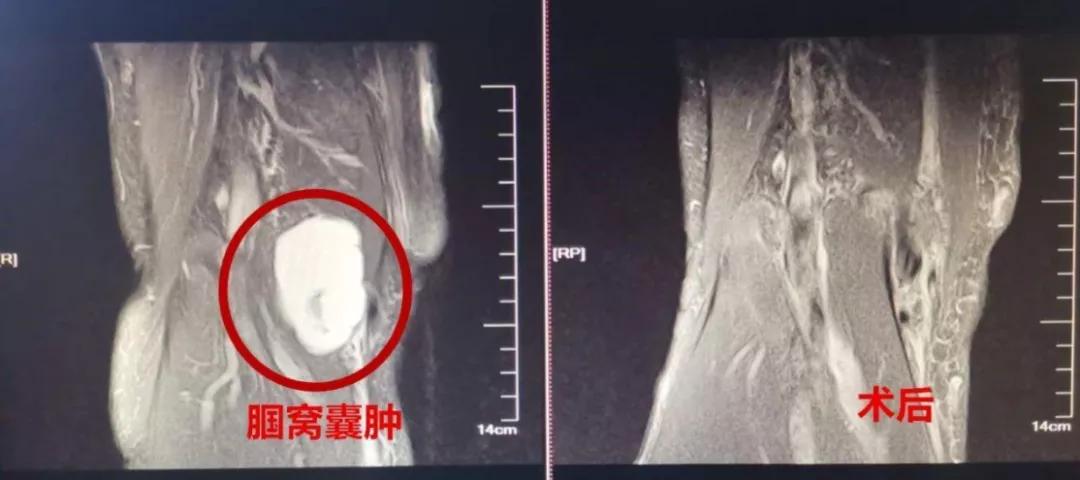 微创手术能治好骨性关节炎吗,膝盖关节镜微创手术要脱衣服吗