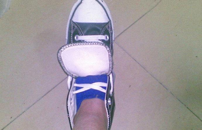 鞋舌总跑偏怎么矫正走姿,如何一招解决鞋舌跑偏