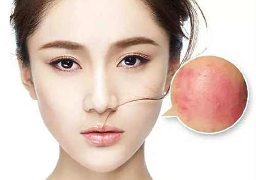 敏感肌肤泛红有斑怎么修复,脸上泛红敏感肌肤的注意事项