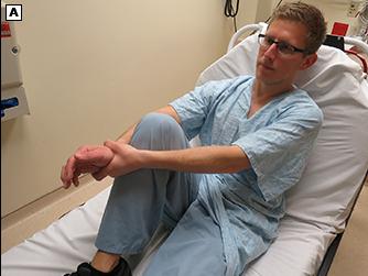 肩膀脱臼了？有一种新方法，能让你自己复位回去，像“陈真”一样