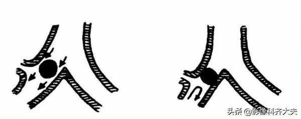 ct能查出气管微小异物嘛,气管异物ct怎么做