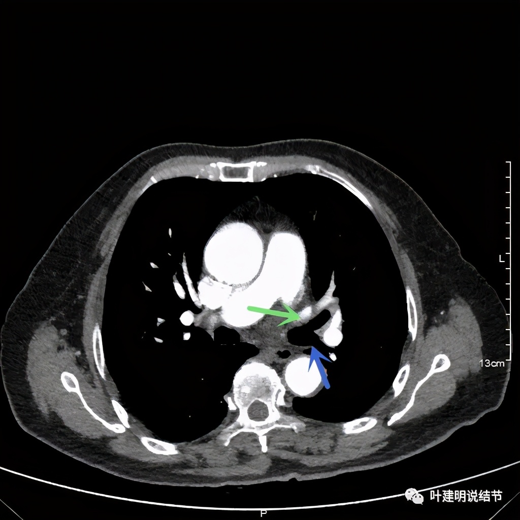 卡瑞利珠单抗治疗肺鳞癌有用吗,特瑞普利单抗对鳞癌治疗有效吗