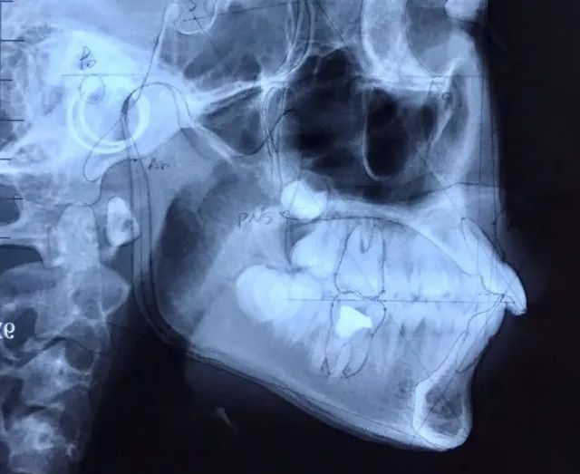 轻微嘴突正畸能达到正颌的效果吗,嘴歪正颌还是正畸怎么判断