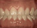 牙齿深覆合龅牙矫正过程,龅牙地包天怎么弄