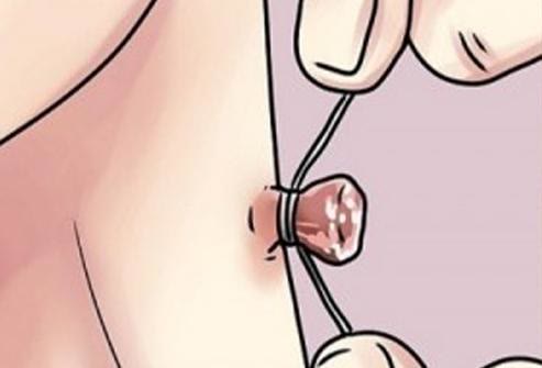 脖子旁边出现小肉粒能直接揪掉吗,脖子和腋下长的小肉揪怎么去除