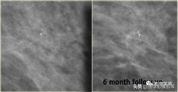 乳腺钙化怎么区分良性和恶性,乳腺钙化的诊断与分级