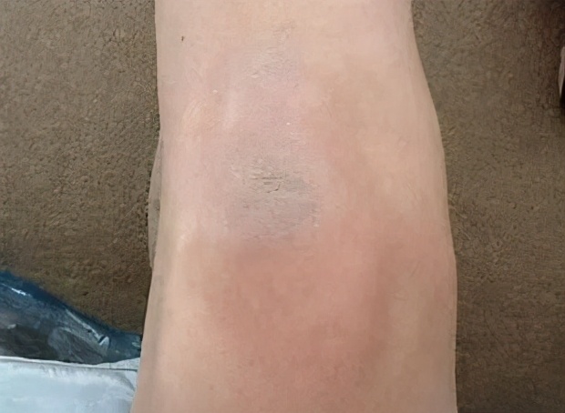 老寒腿膝盖保暖,老寒腿有救了吧