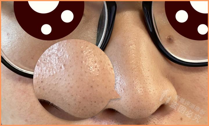 毛孔粗大怎么办教你一招收缩毛孔,毛孔粗大怎么办教你拯救方法