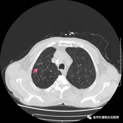多发原发肺癌能根治吗,肺部原发性恶性肿瘤好治