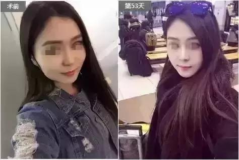 瘦脸针的5个常见问题,瘦脸针其实副作用挺大的