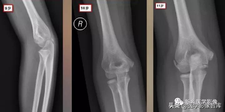 肘关节x线测量,肘关节骨骺示意图