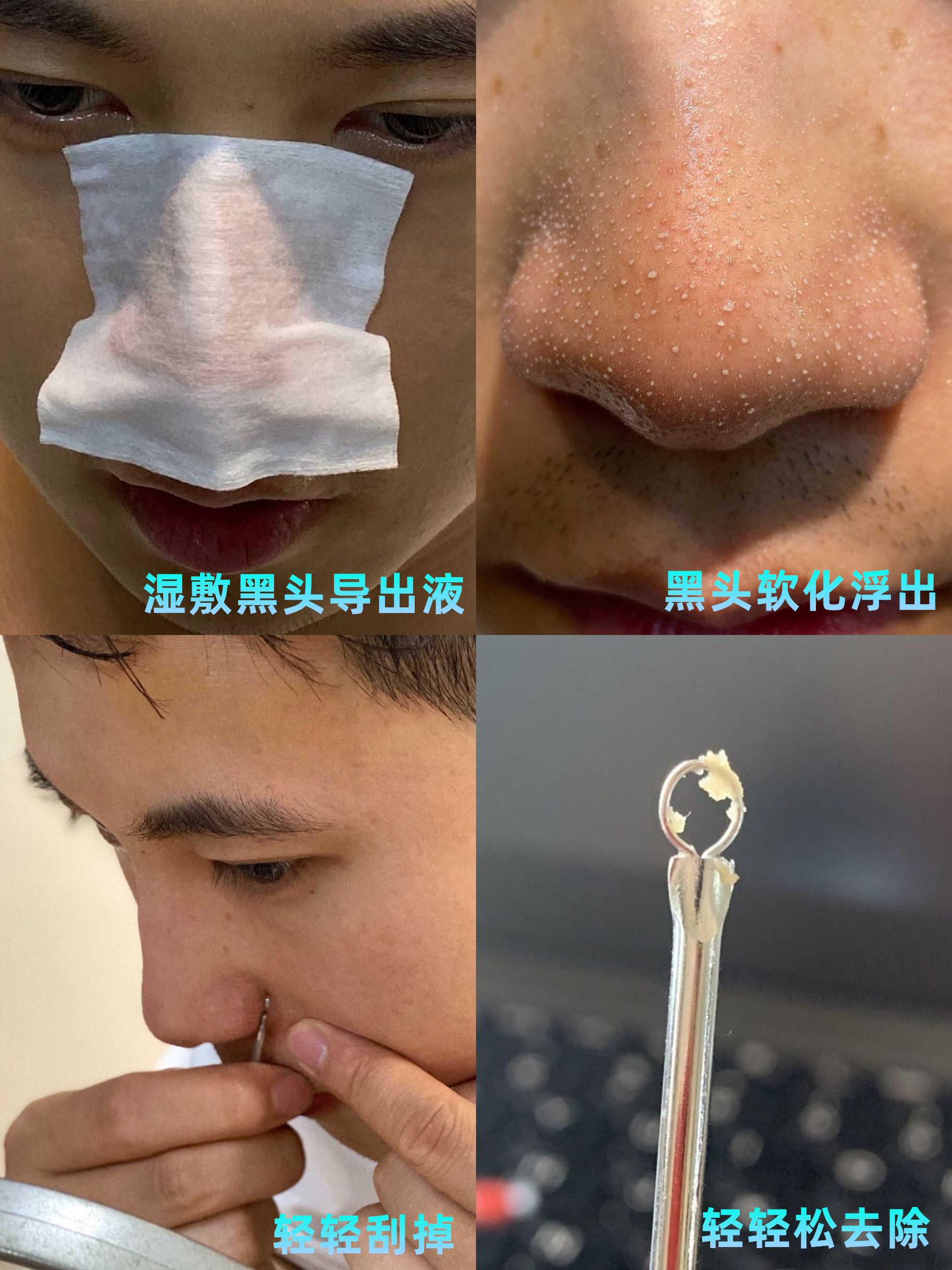 黑头如果不管它会一直在鼻子上吗,不管黑头行吗