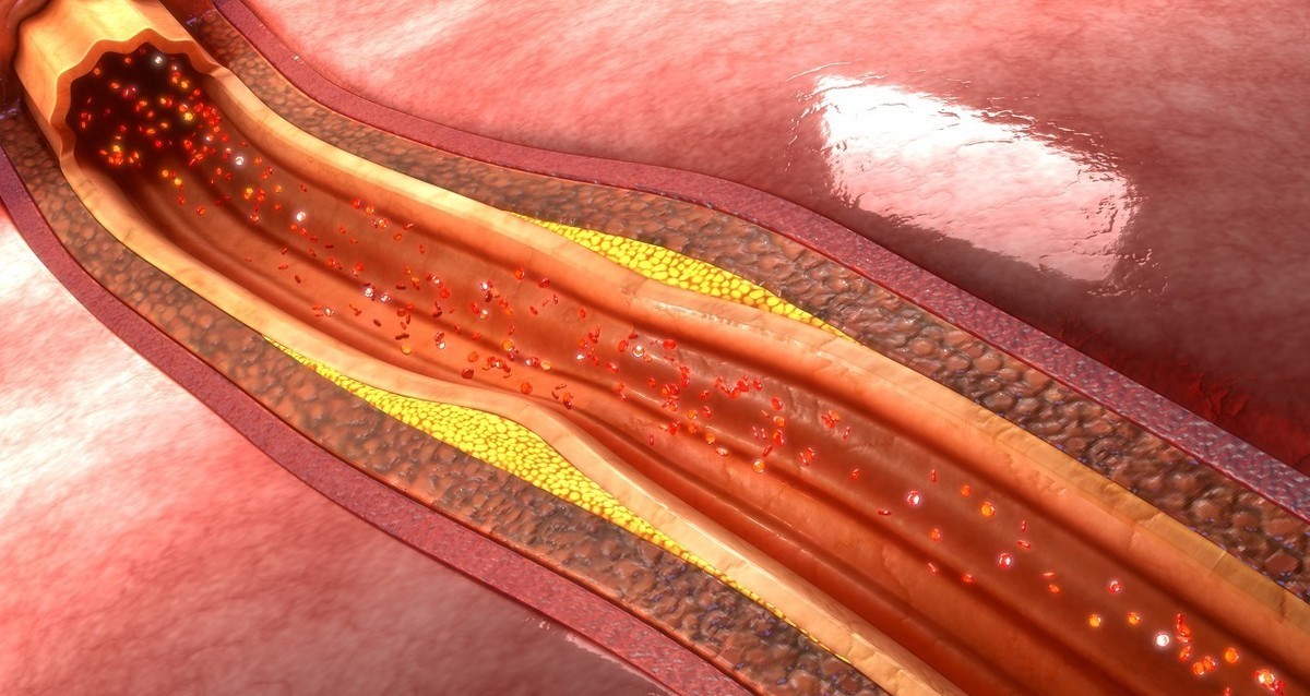 颈动脉斑块与阿司匹林,颈动脉斑块吃他汀还是阿司匹林好