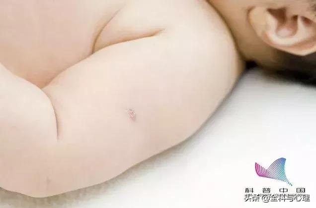 胳膊上莫名其妙的长疤怎么来的,胳膊上的疤是怎么来的