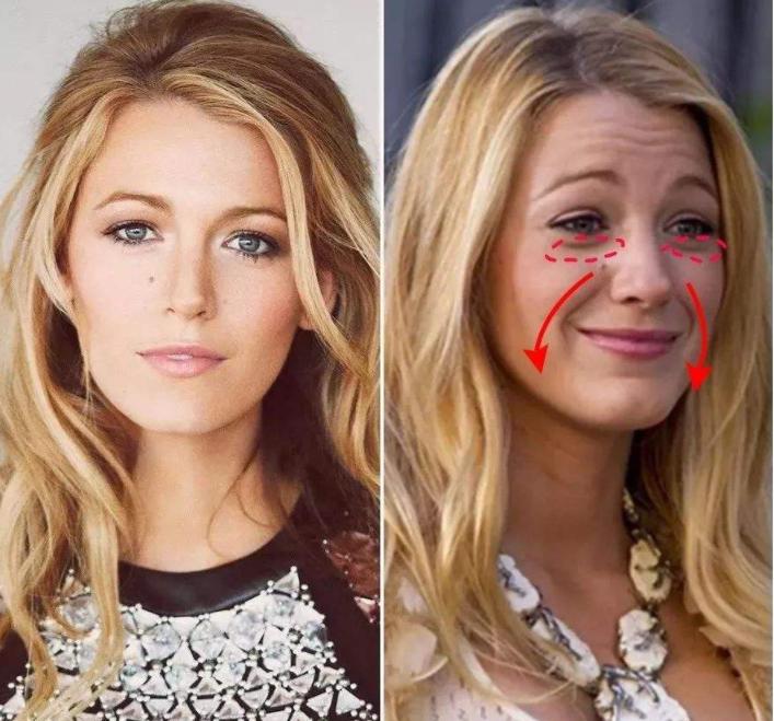 法令纹最显老怎么去除法令纹,法令纹太深了怎么改善