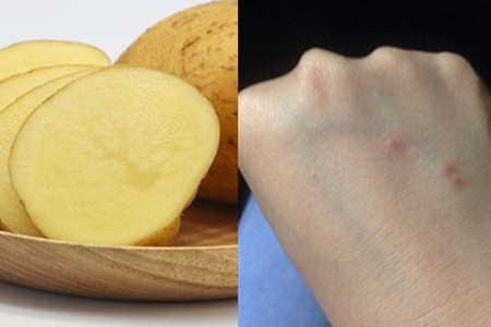 贴土豆片消肿一般贴多长时间,贴土豆片真的就能够消肿止痛吗