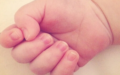 小孩身上的血管瘤饮食要注意什么,婴儿草莓状血管瘤需要注意什么