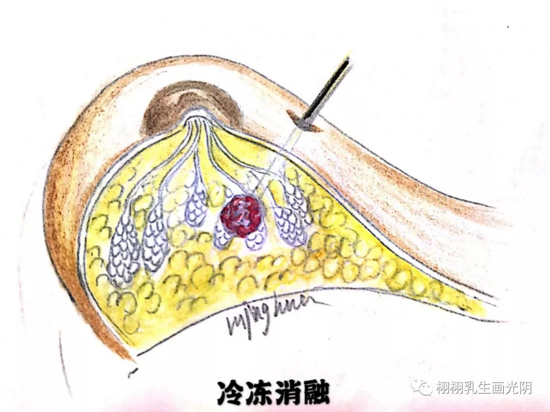 乳腺癌的照妖镜钼靶检查,乳腺癌的照妖镜检查