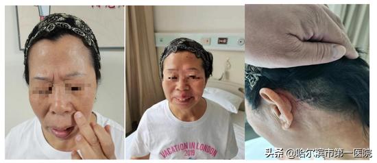 长春市血管减压术,南京微血管减压术