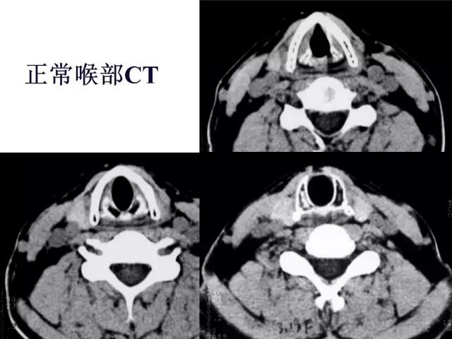 喉部病变做核磁还是ct,耳鼻喉科常见病影像诊断