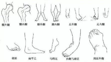 儿童常见的步态异常有哪些类型,孩子哪些步态异常需要警示