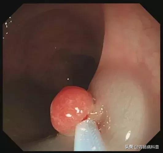 只要是肠息肉都要割掉吗,医生肠息肉切除后怎么处理伤口