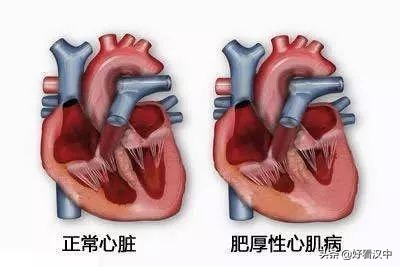 汉中科普：长跑10年，却跑出了心脏病！汉中人你知道正确的运动方式吗？