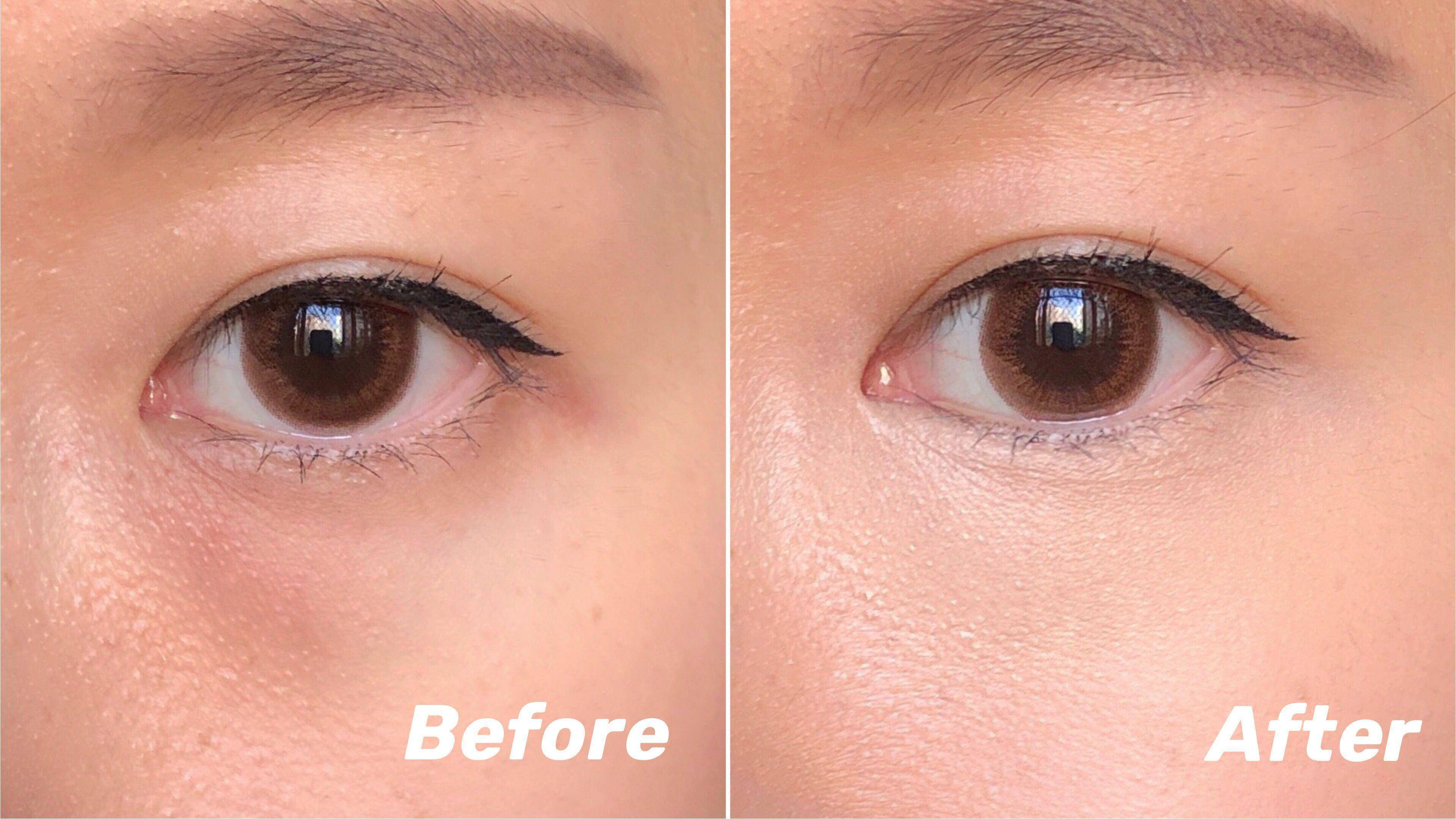 熬夜引起的泪沟黑眼圈能消失么,万年黑眼圈眼袋泪沟怎么遮瑕