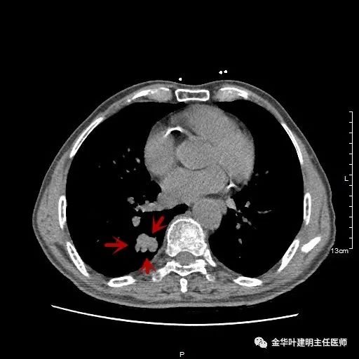 多发原发肺癌能根治吗,肺部原发性恶性肿瘤好治