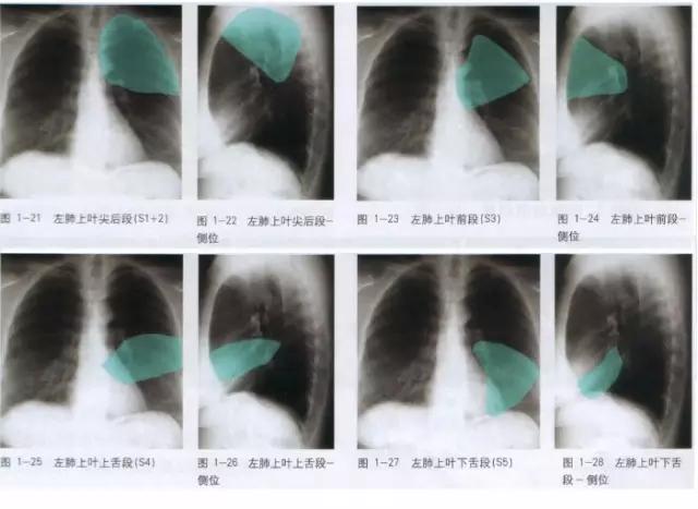 收藏：详细的胸部X线解剖，最基础最实用