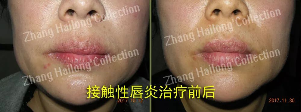 唇炎反复和口红有关系吗,都是红唇惹的祸