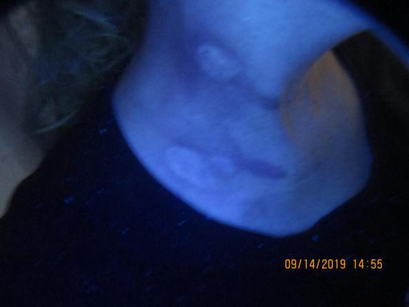 从确诊到康复,仅4个月,颈部白癜风患者王女士分享成功经验