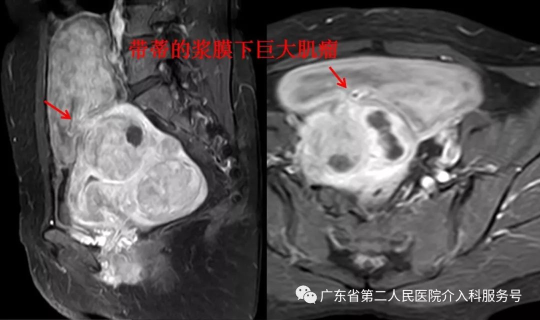 多发子宫肌瘤浆膜下,浆膜下多发子宫肌瘤怎么办