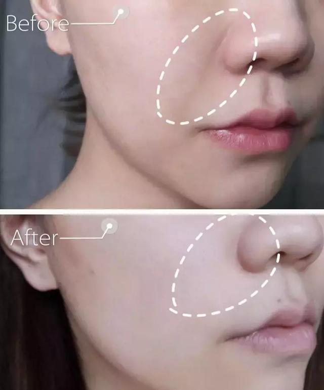 硬刚女皇龙妈也扛不住法令纹,2条沟壑让人心疼,贴一贴就消了