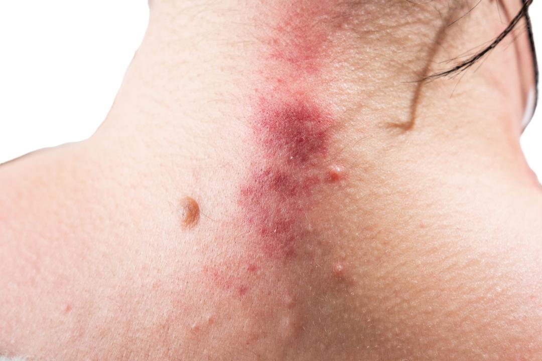 出痧有颗粒是怎么回事,出痧后有瘀青怎么办