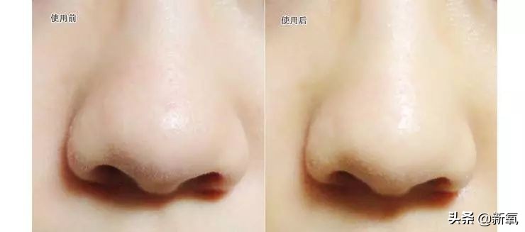 亲测非常有效的去黑头方法,去黑头最有效的方法三天见效